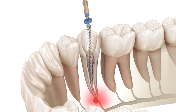 endodontie infection pulpaire paris racine Retraitement endodontique Dentiste Attuil Régis | Endodontie à Paris 17