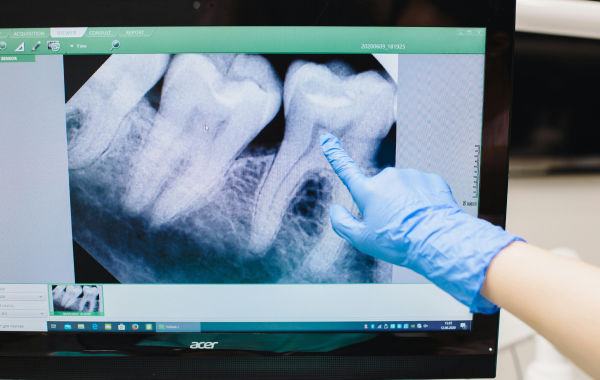 infection pulpaire paris racine Retraitement endodontique Dentiste Attuil Régis | Endodontie à Paris 17