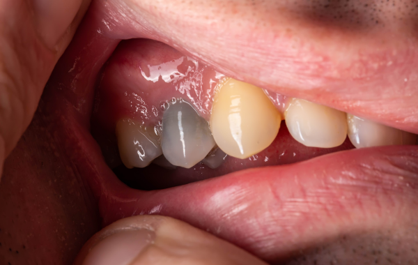 infection pulpaire paris soins endodontie Traitement de nécrose Dentiste Attuil Régis | Endodontie à Paris 17