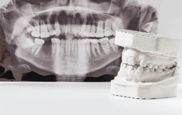 Traitement des traumatismes Dentiste Attuil Régis | Endodontie à Paris 17