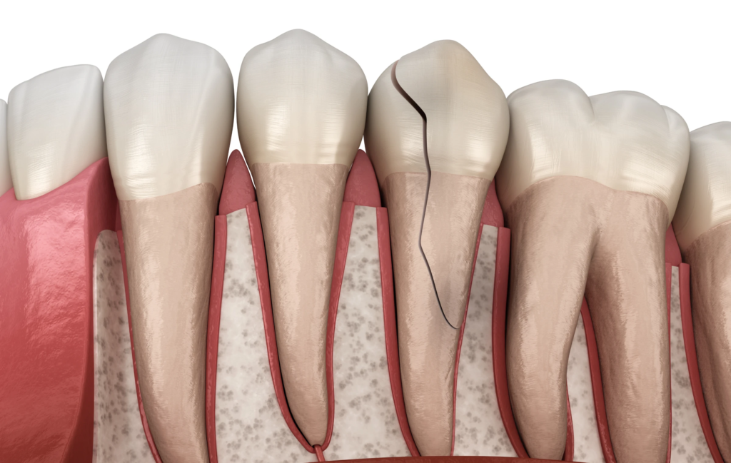 Traitement des traumatismes Dentiste Attuil Régis | Endodontie à Paris 17